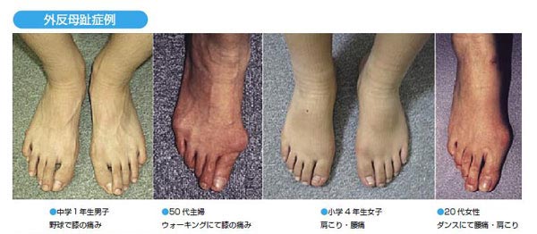 外反母趾の治療をしていない異常のある足裏。