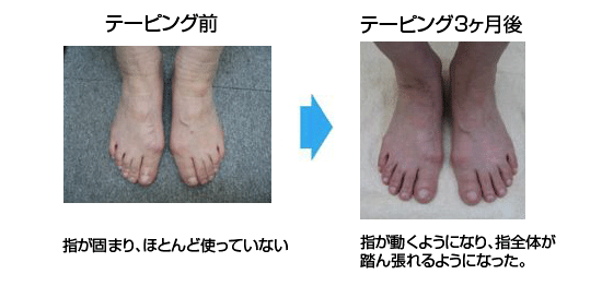 笠原先生の外反母趾治療で痛みを改善された斉藤和江様の足。