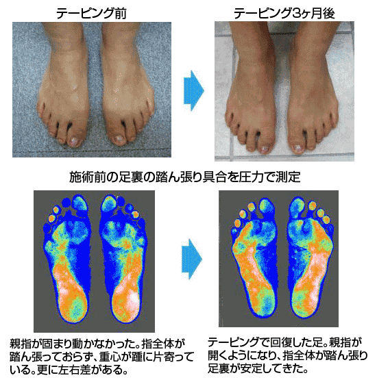 笠原先生の外反母趾治療で痛みを改善された西沢裕子様の足。