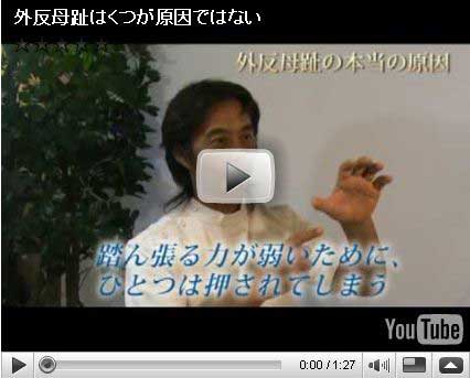 外反母趾の治療について笠原巖先生が動画でご説明しています。
